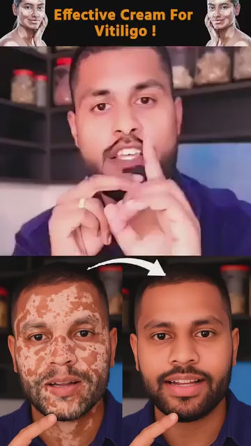 VitiGO Bee Venom Correcting Cream – Skin Pigmentation & Melanocyte Restoration (20g)